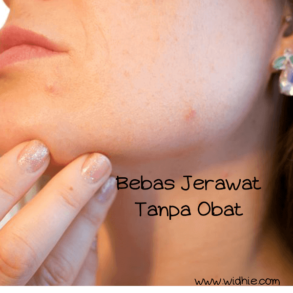 Bebas Jerawat Tanpa Obat